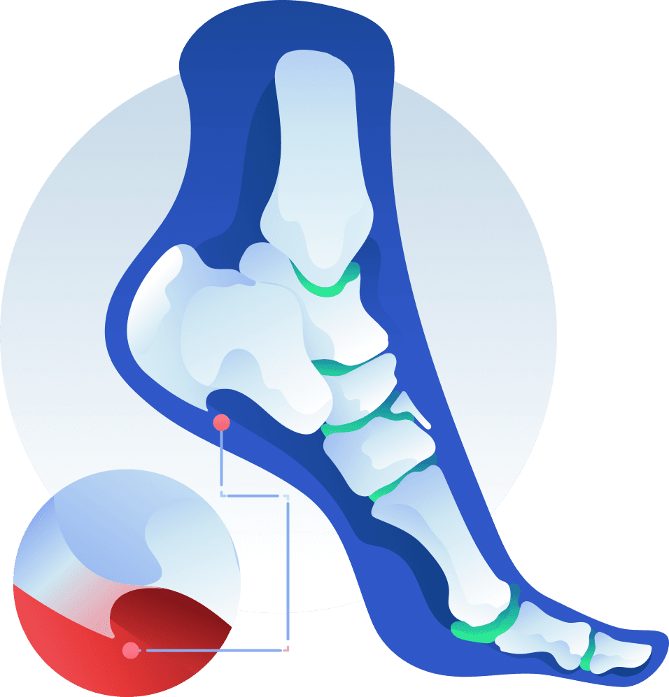 Heel Spurs: Symptoms, Causes, and Treatment