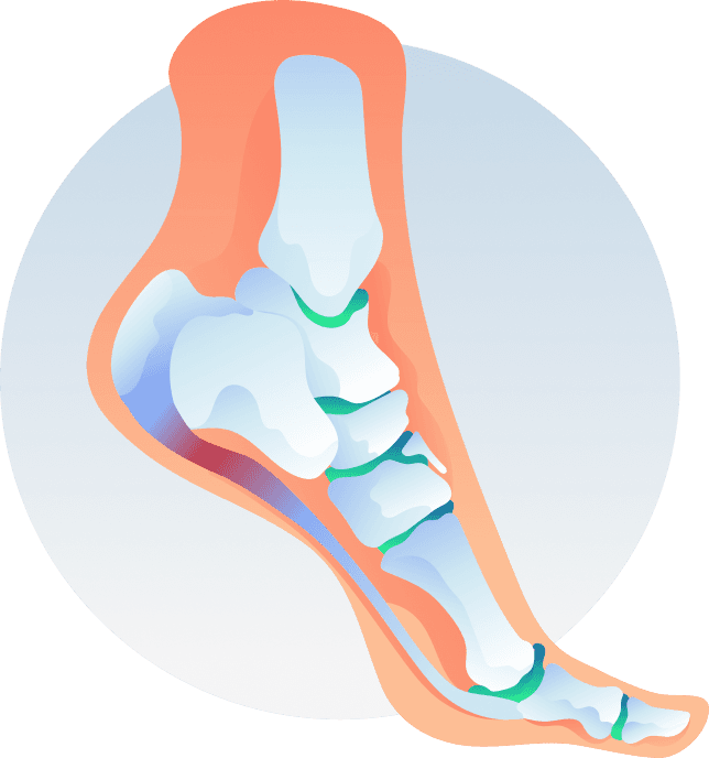 Plantar Fasciitis Symptoms, Causes, and Treatment